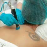 Back view of a medical professional using laser equipment on patient for skincare treatment.